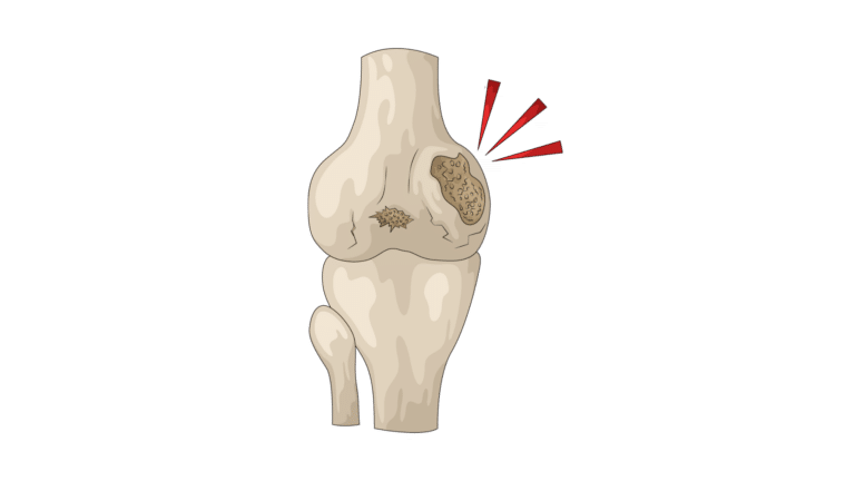 Artros transp bakgrund Artros transp bakgrund