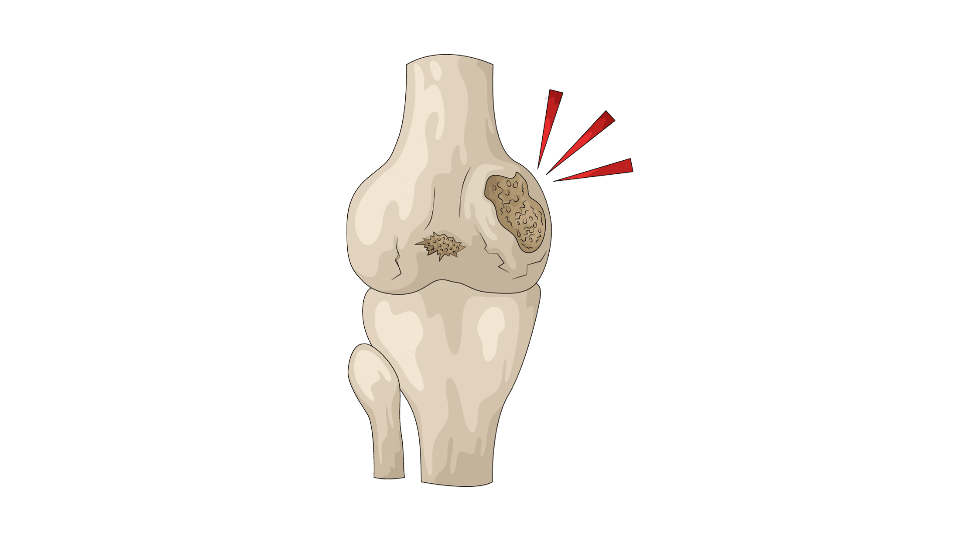 Artros transp bakgrund